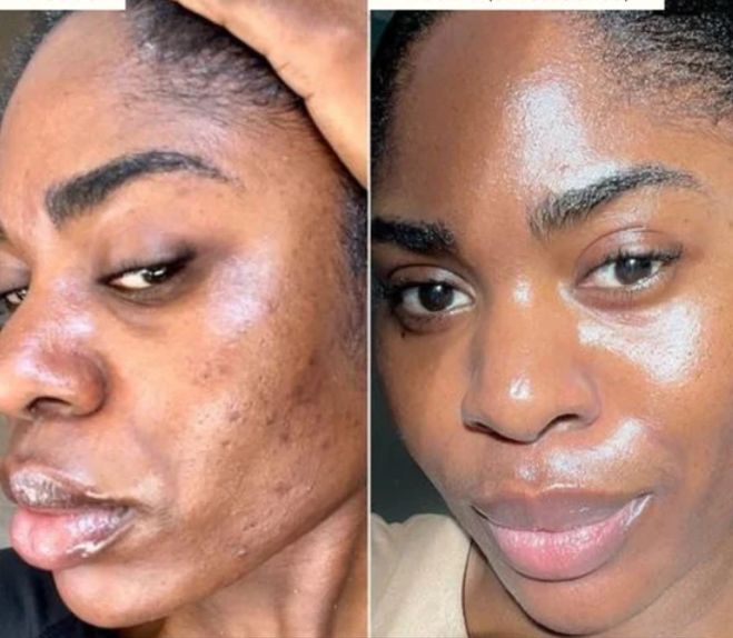 Natural Fix – Combo anti acné y manchas
