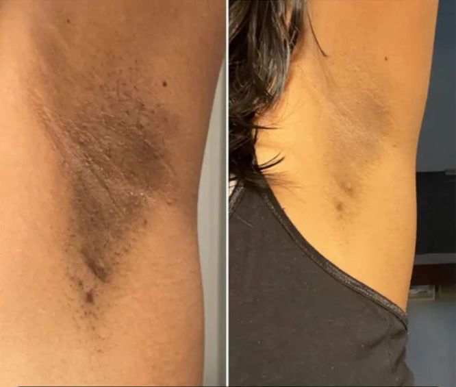 Natural Fix – Combo anti acné y manchas
