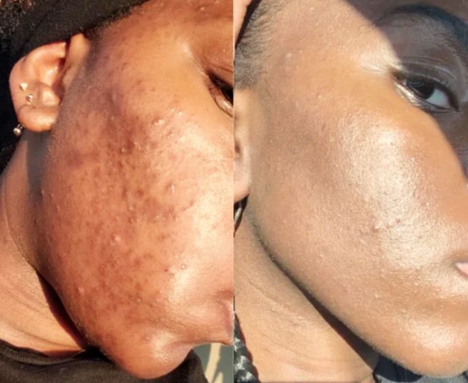 Natural Fix – Combo anti acné y manchas